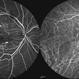 Multifocal CSCR 2 Multifocal CSCR 2
